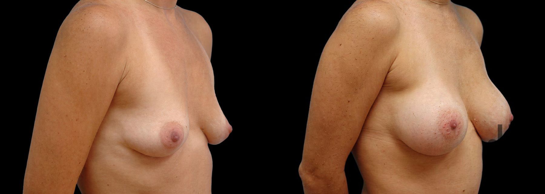 Before and after Breast Augmentation case 42623 - Angle 2