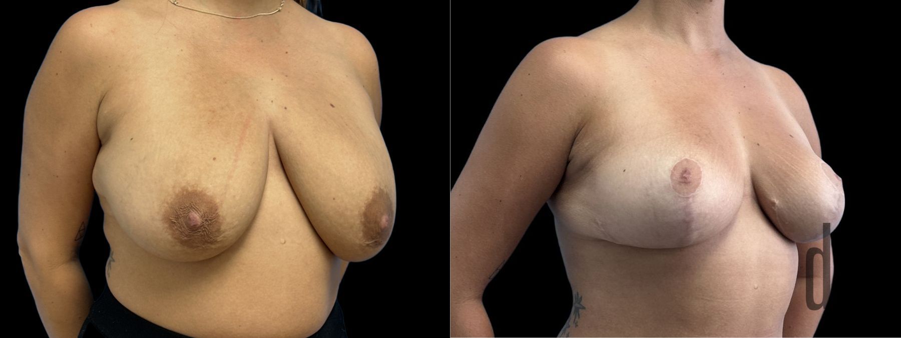 Before and after Breast Reduction case 41238 - Angle 2