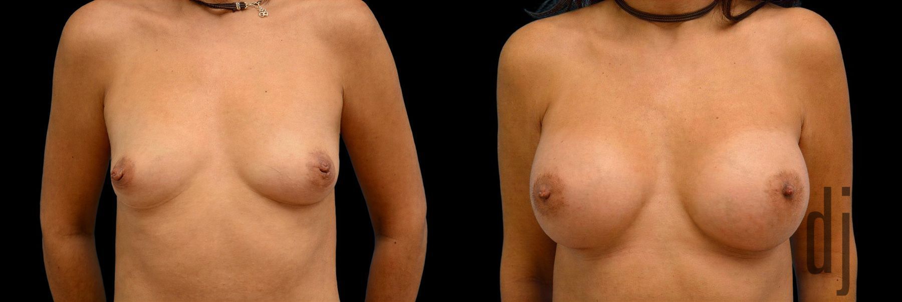 Before and after Breast Augmentation case 42829