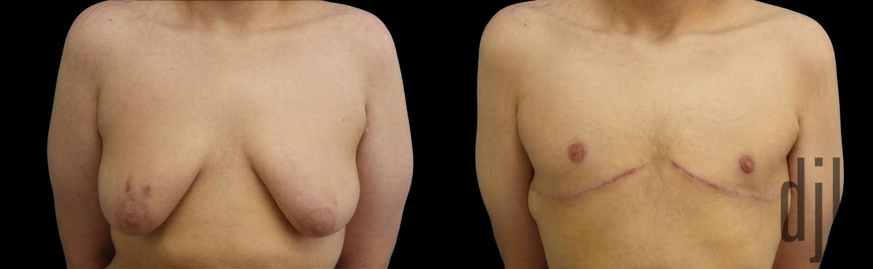 Before and after Gynecomastia case 42807