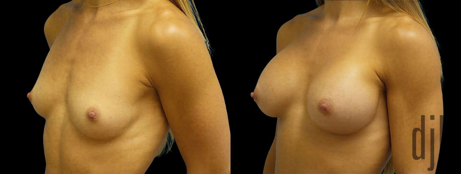 Before and after Breast Augmentation case 43002 - Angle 2