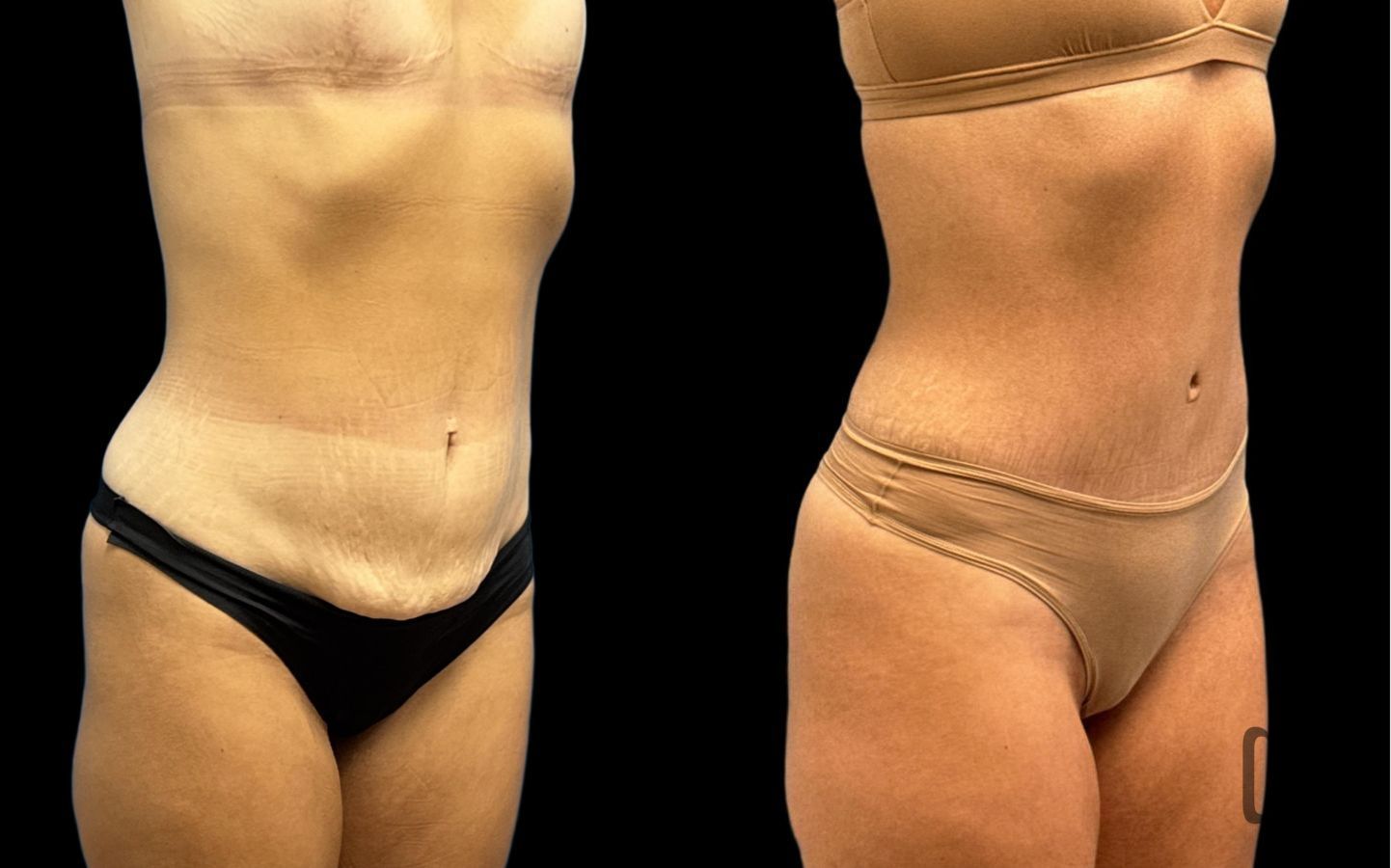 Before and after Tummy Tuck case 33056 - Angle 2