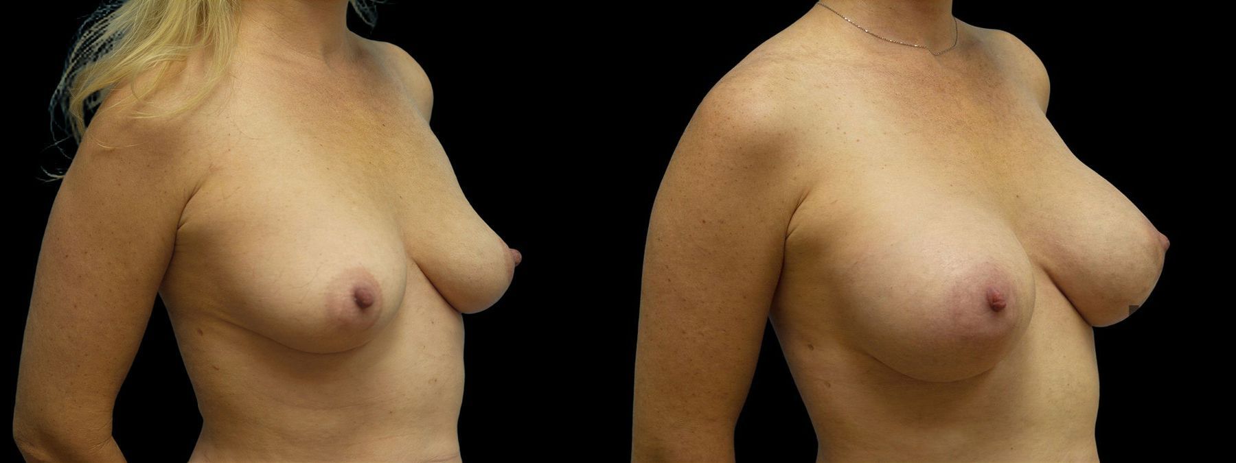 Before and after Breast Augmentation case 42966 - Angle 2