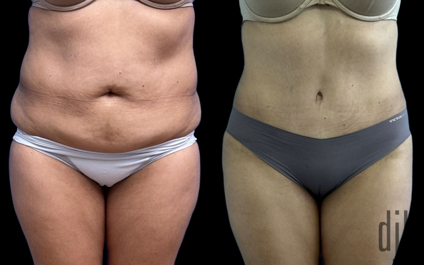 Before and after Tummy Tuck case 37378