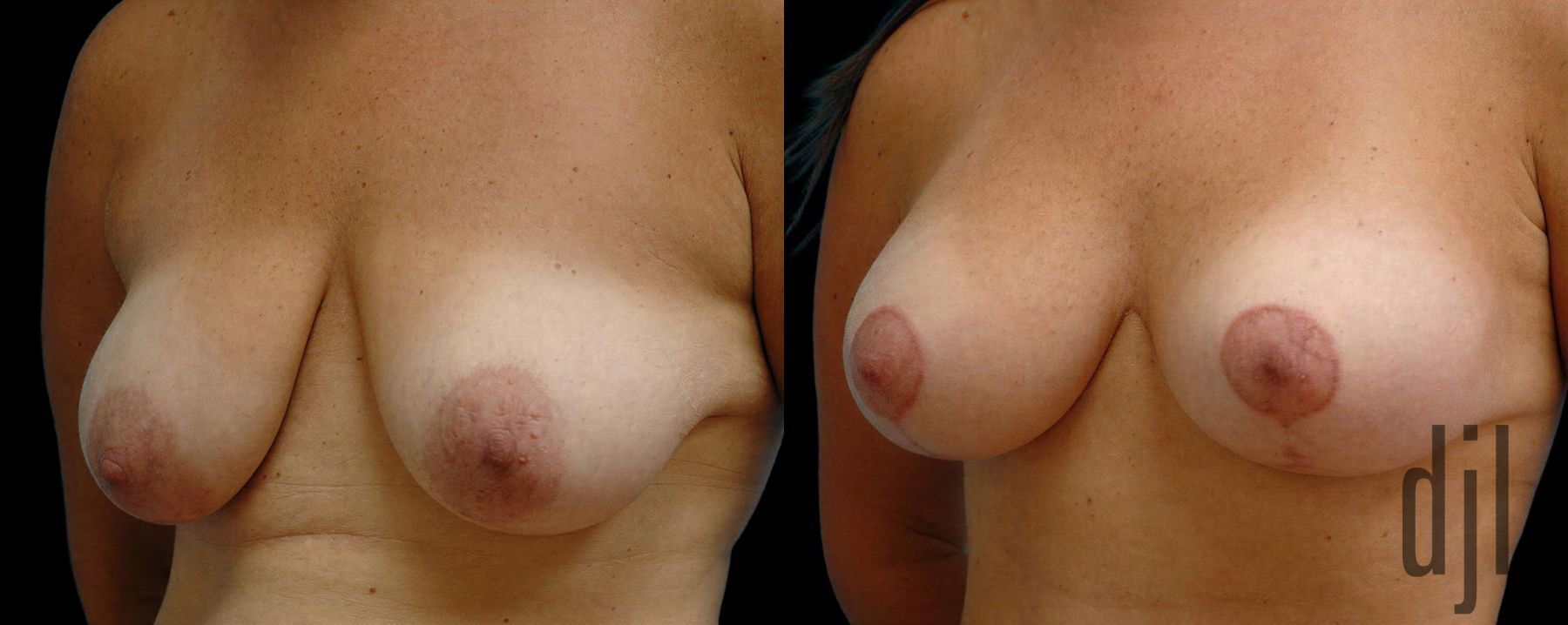 Before and after Breast Augmentation with Lift case 42619 - Angle 2