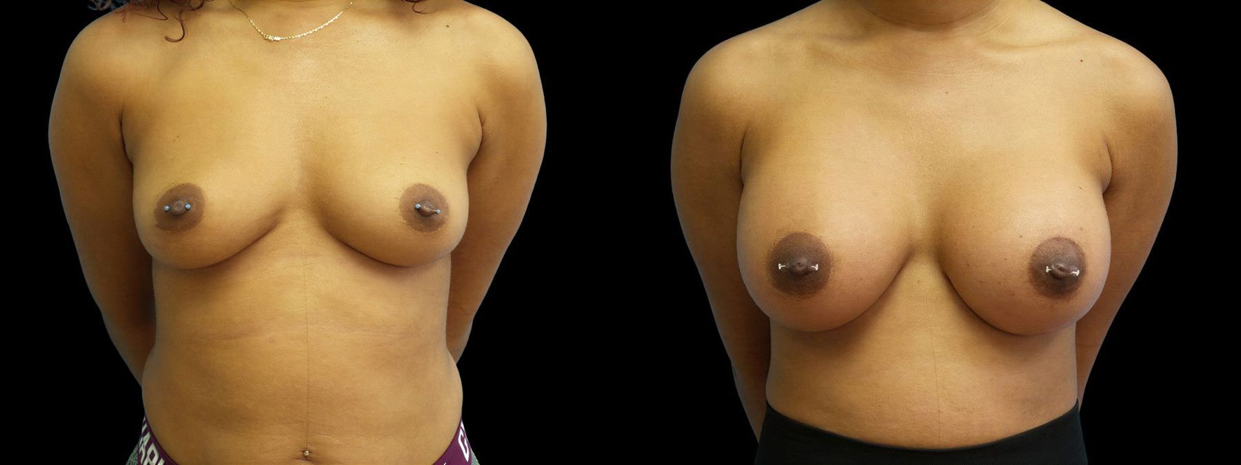 Before and after Breast Augmentation case 43021