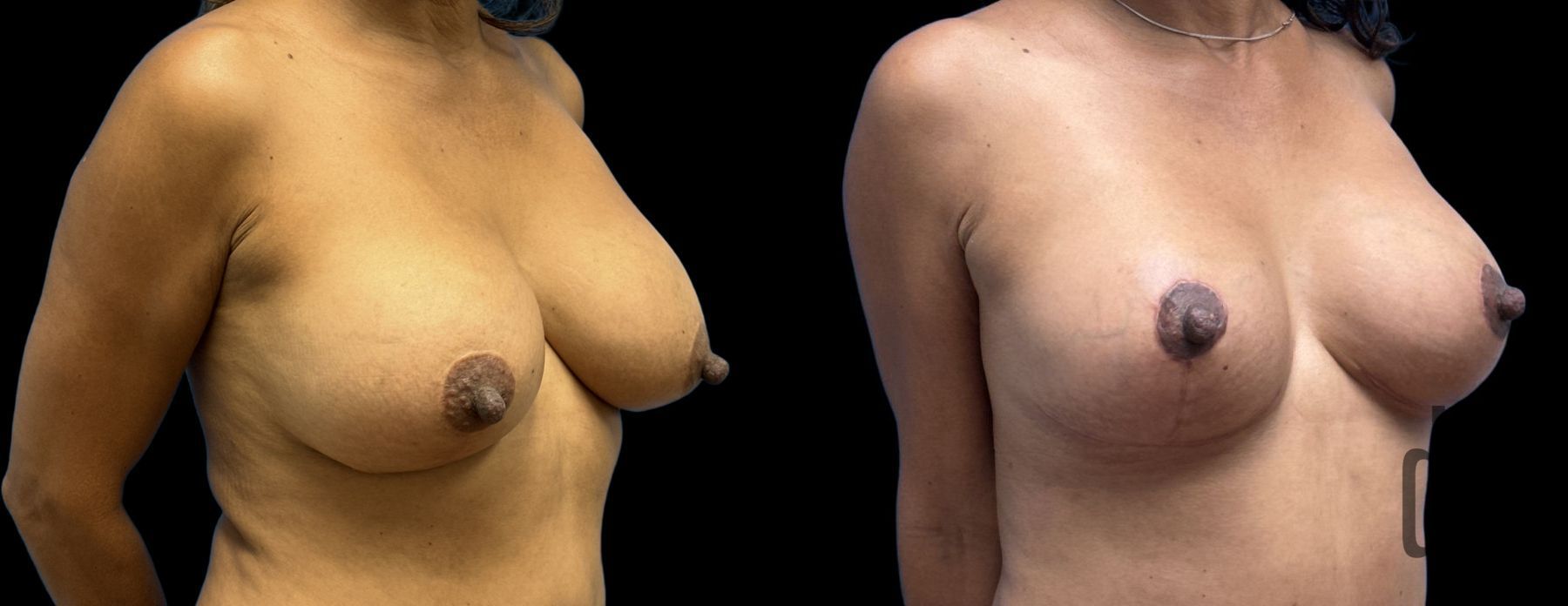 Before and after Implant Replacement Mastopexy case 33064 - Angle 2
