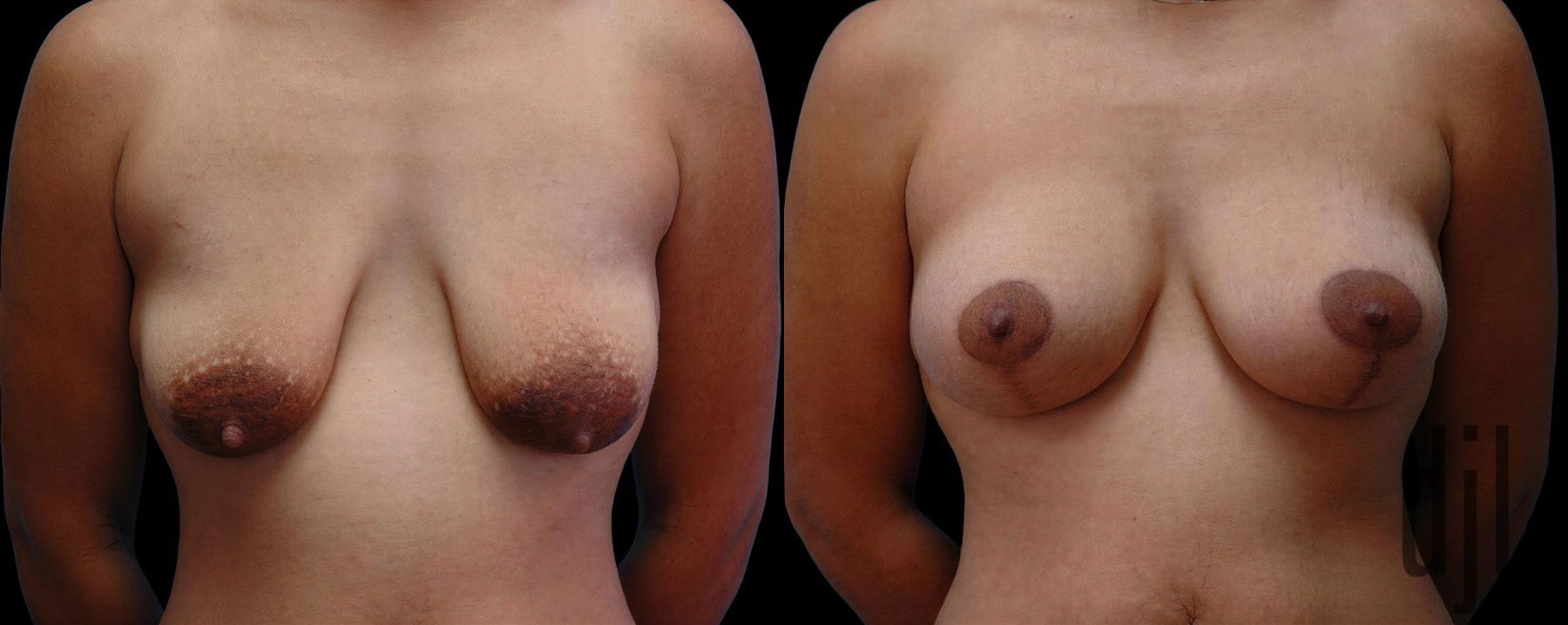 Before and after Breast Augmentation with Lift case 42659