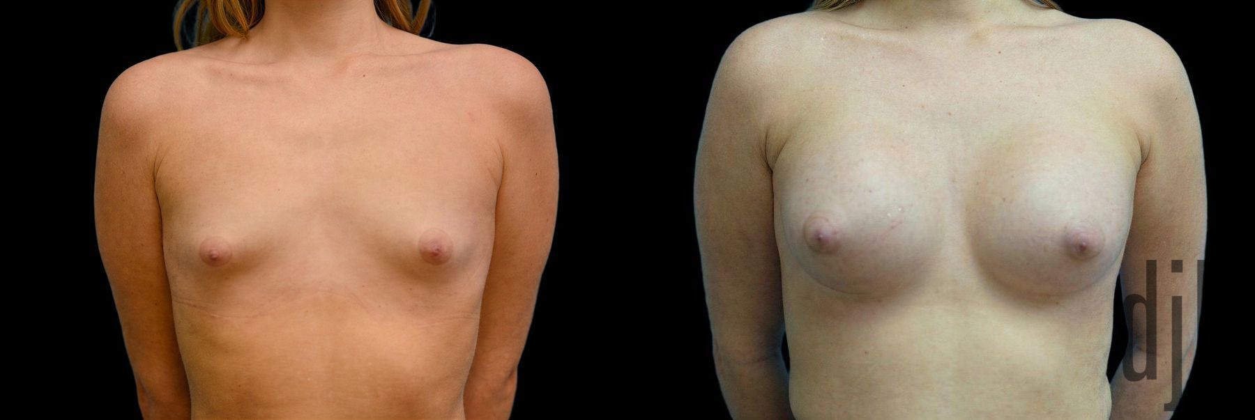 Before and after Breast Augmentation case 42906