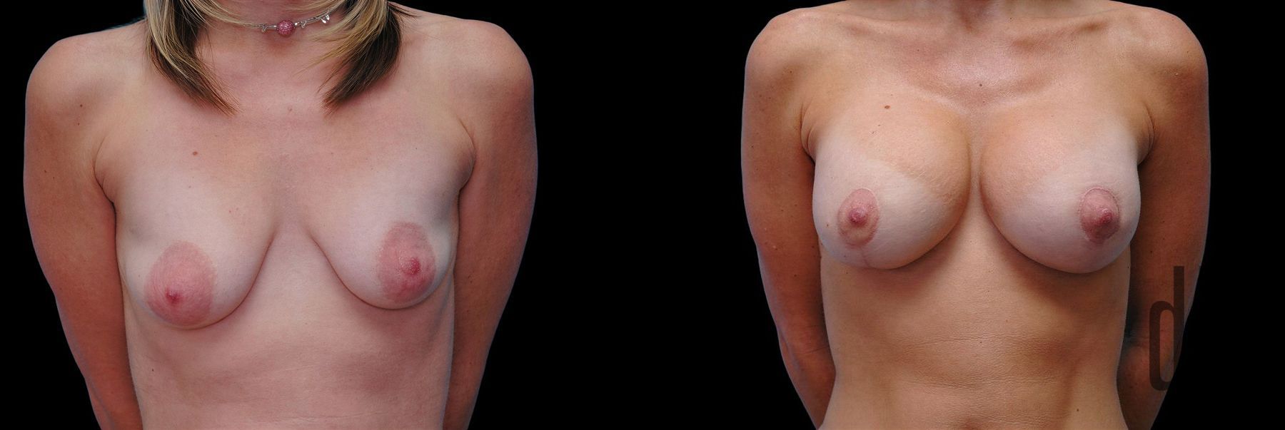 Before and after Breast Augmentation with Lift case 42862