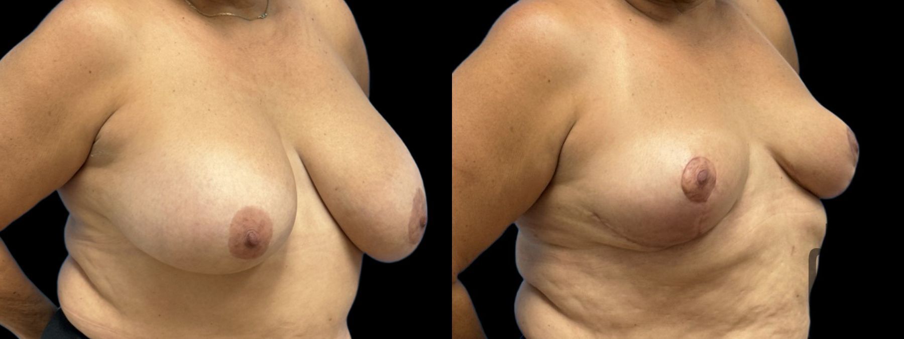Before and after Explant Mastopexy case 41346 - Angle 2