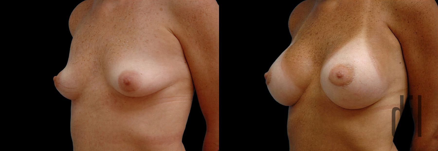 Before and after Breast Augmentation case 42554 - Angle 2