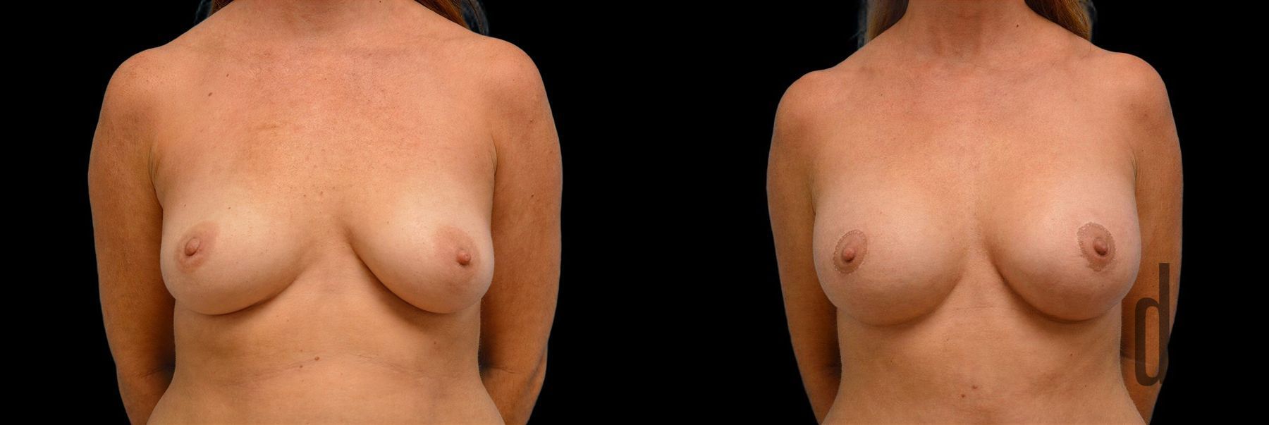 Before and after Breast Augmentation with Lift case 42746