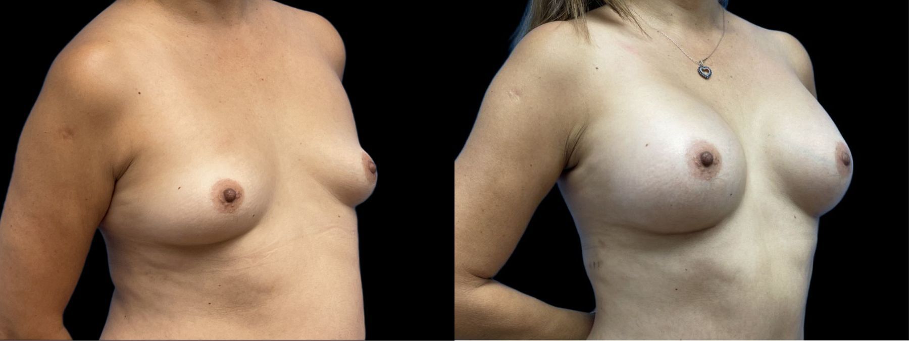 Before and after Breast Augmentation case 41243 - Angle 2