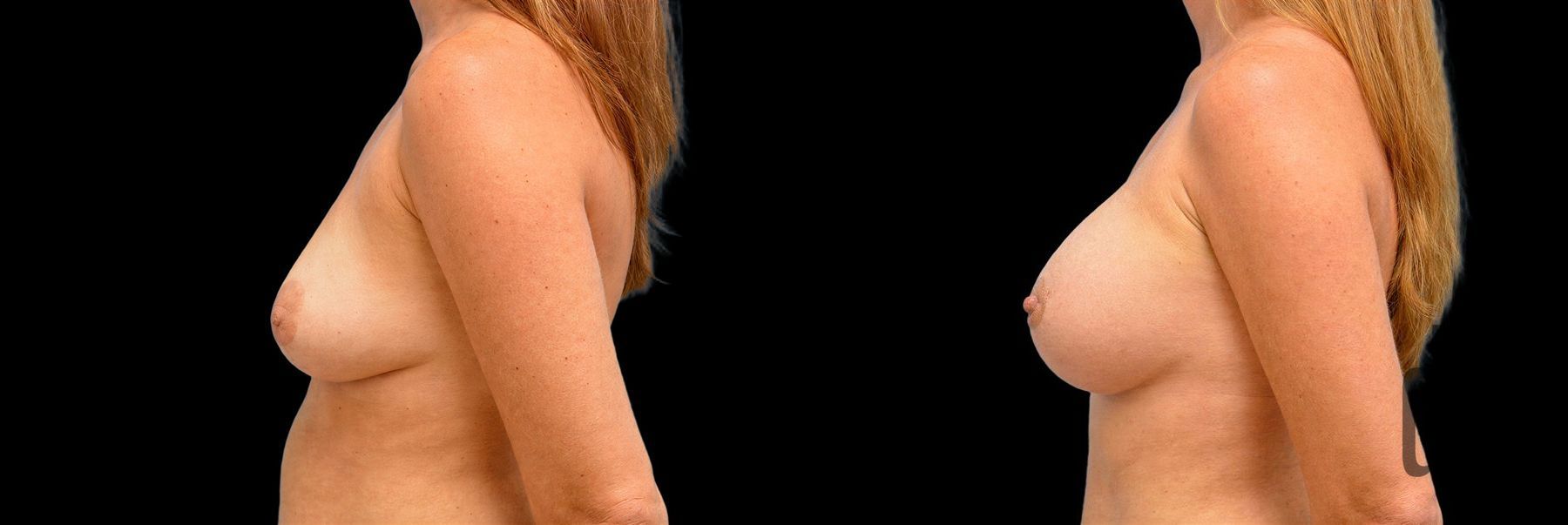 Before and after Breast Augmentation with Lift case 42746 - Angle 2
