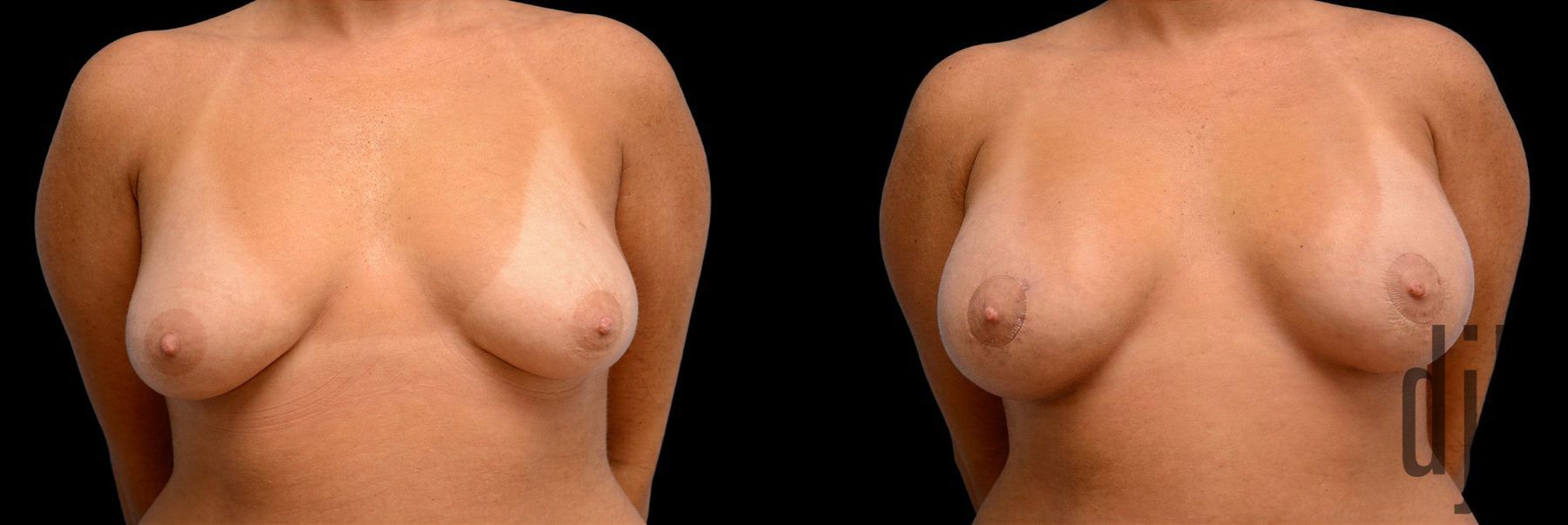 Before and after Breast Augmentation with Lift case 42846
