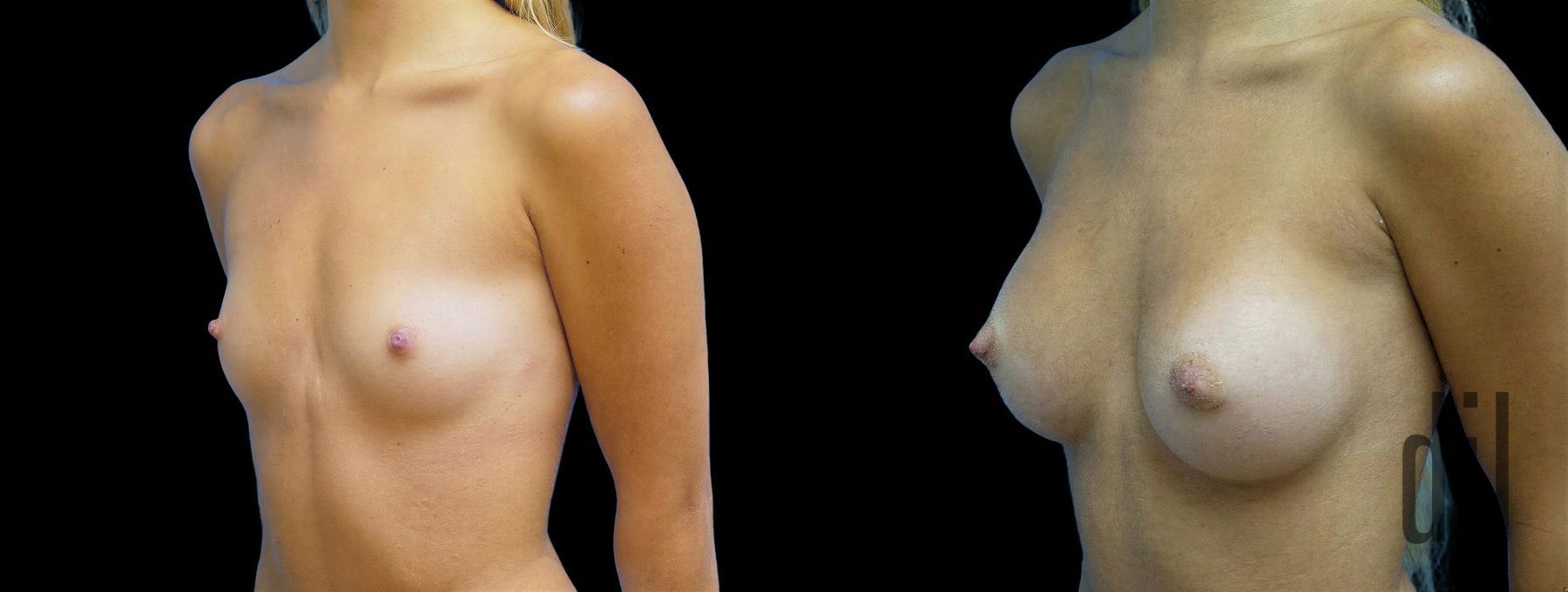 Before and after Breast Augmentation case 42940 - Angle 2