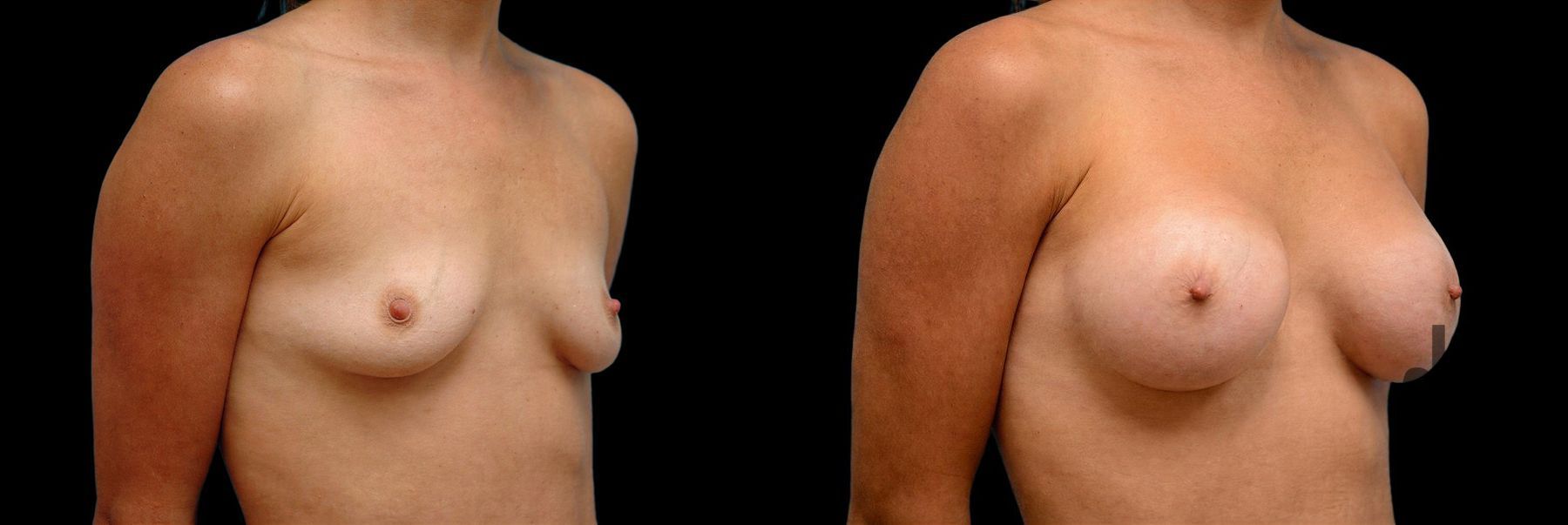 Before and after Breast Augmentation case 42783 - Angle 2