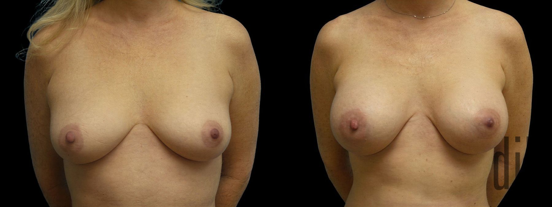 Before and after Breast Augmentation case 42966