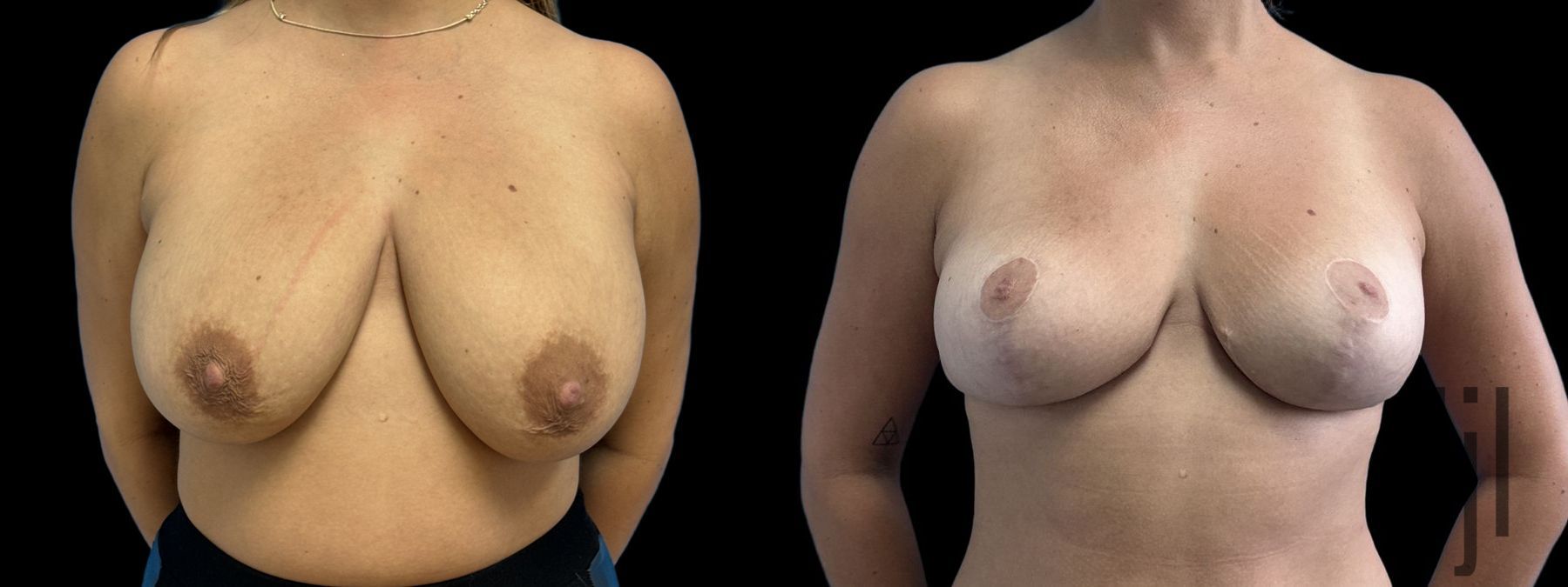 Before and after Breast Reduction case 41238