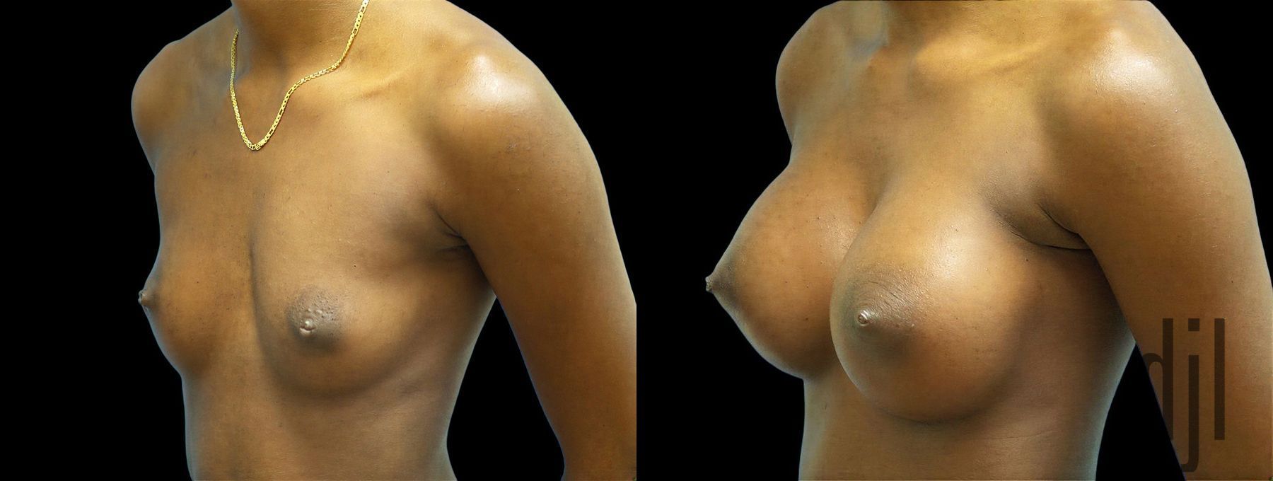 Before and after Breast Augmentation case 43007 - Angle 2