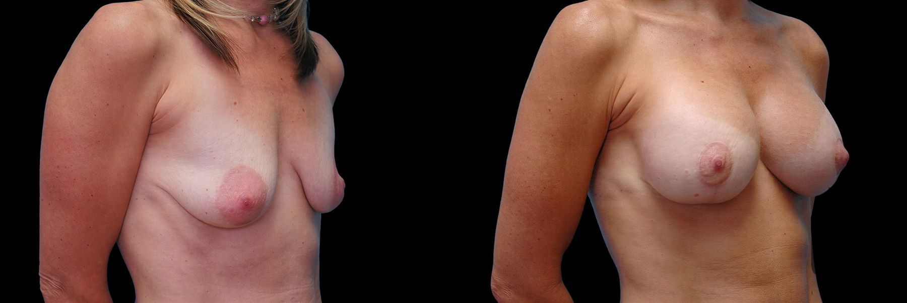 Before and after Breast Augmentation with Lift case 42862 - Angle 2