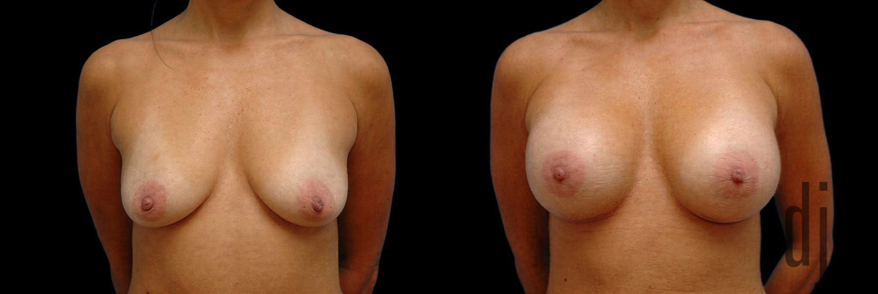 Before and after Breast Augmentation case 42755