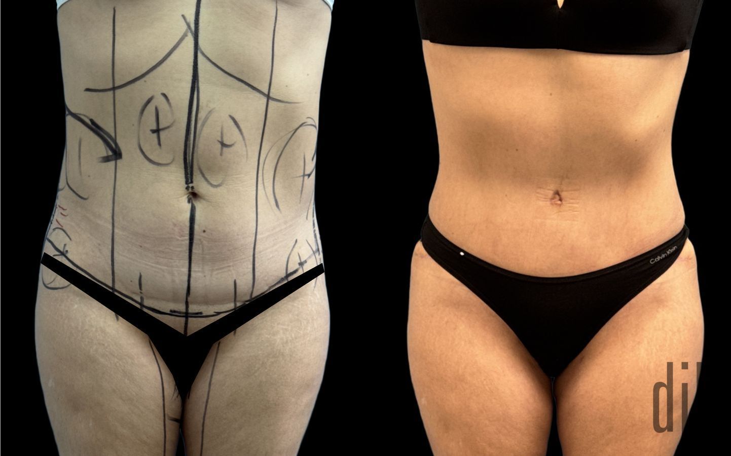 Before and after Liposuction case 33055