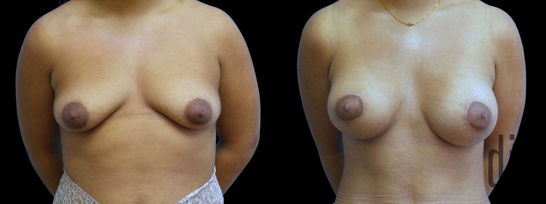 Before and after Breast Augmentation with Lift case 42920