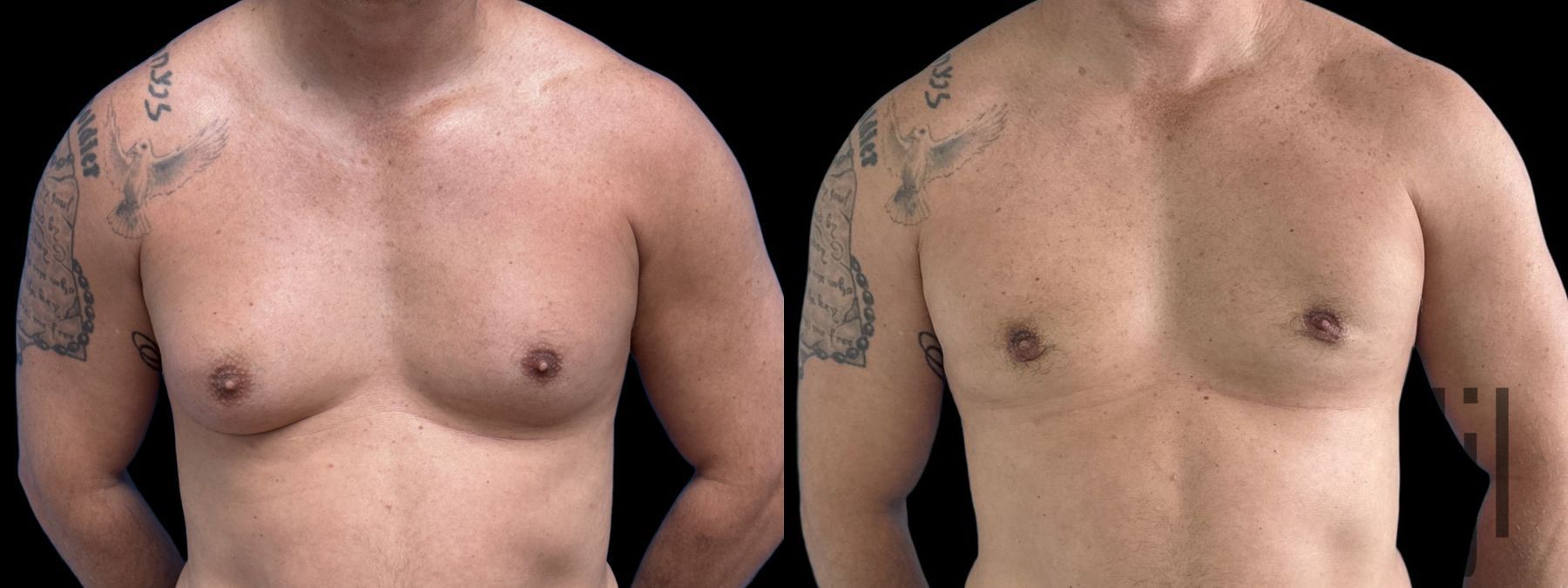 Before and after Gynecomastia case 33063