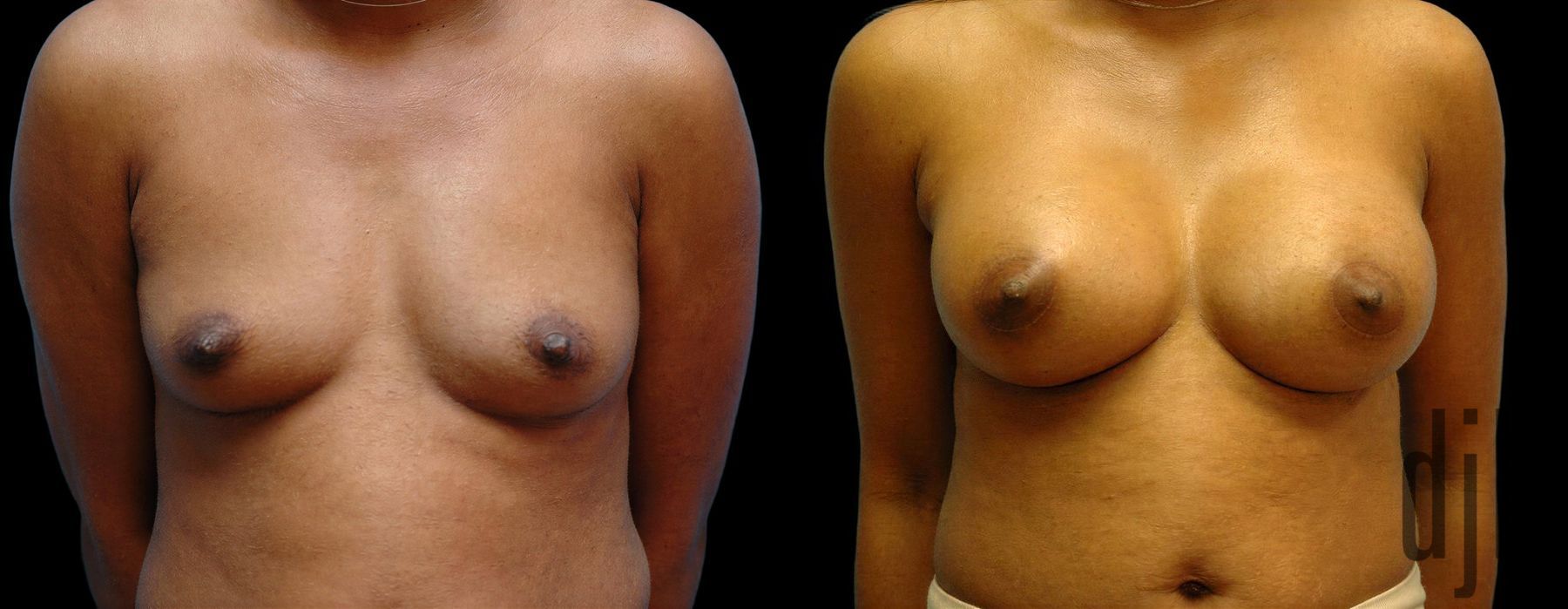 Before and after Breast Augmentation case 42644