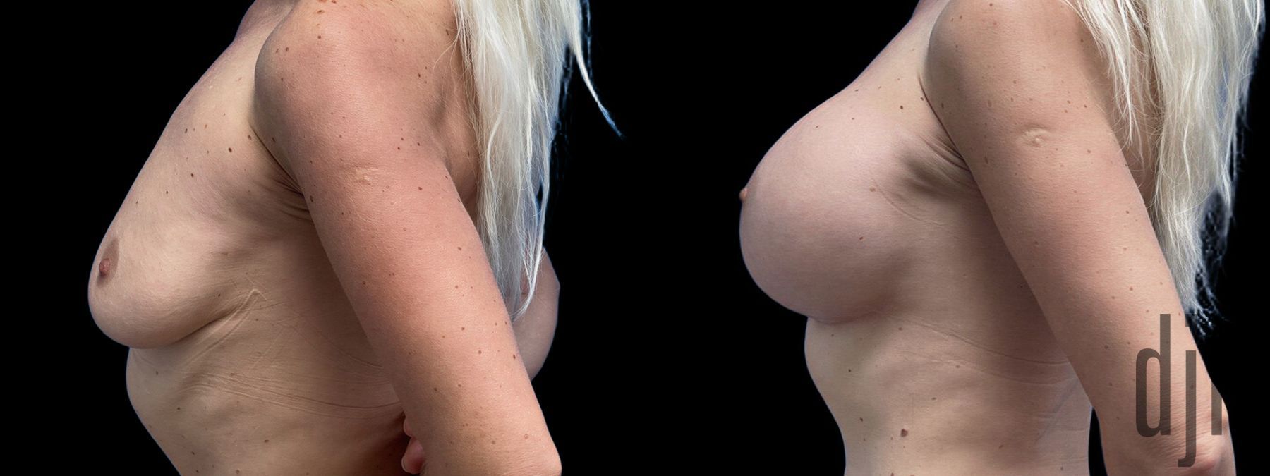 Before and after Breast Augmentation case 41240 - Angle 2