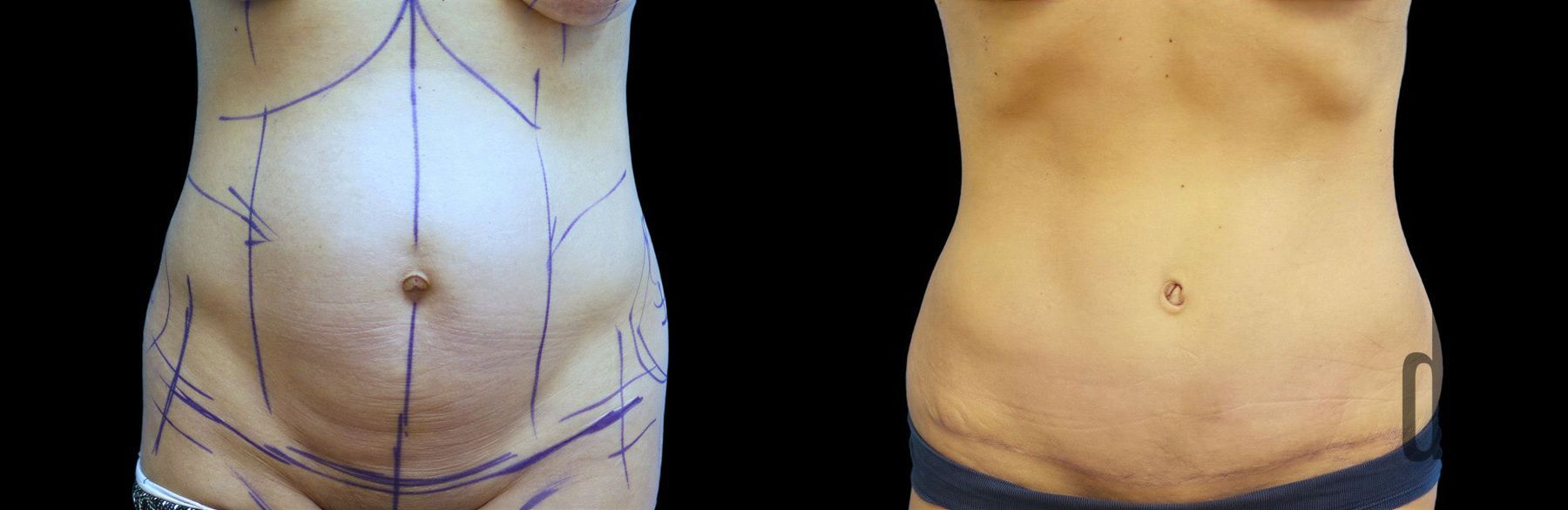 Before and after Tummy Tuck case 42903
