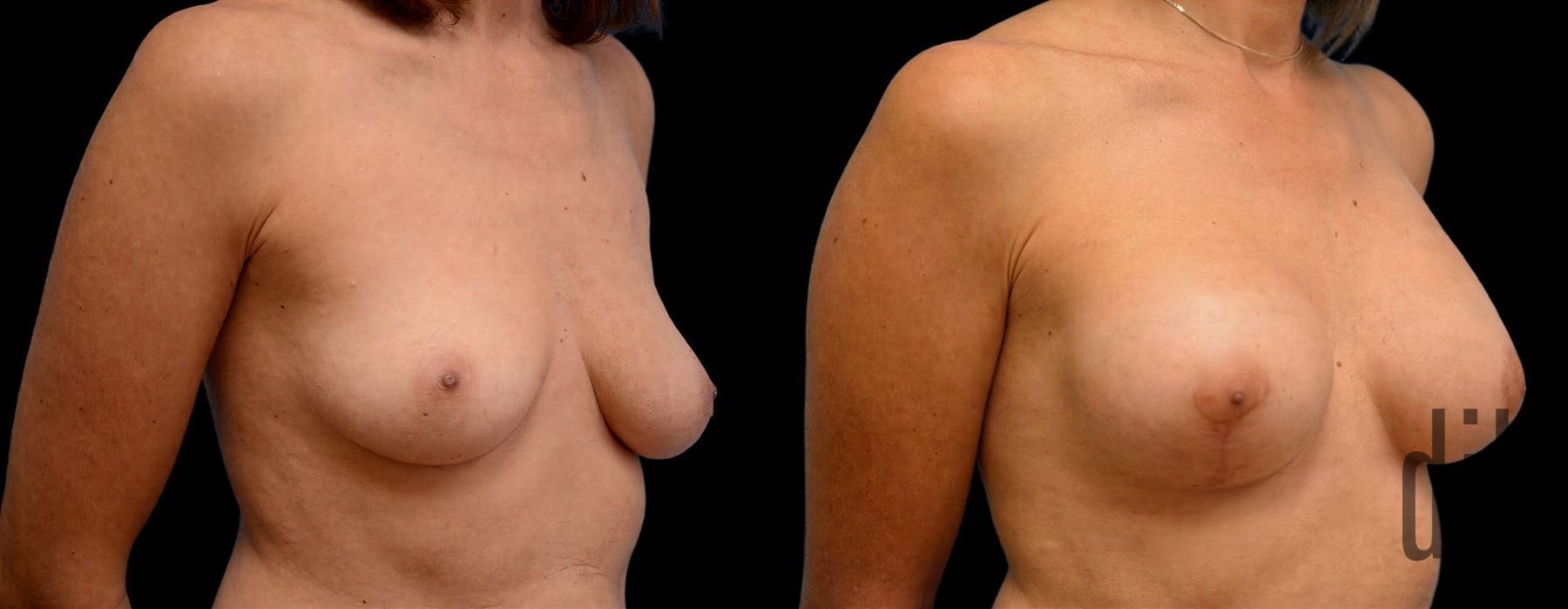 Before and after Breast Augmentation with Lift case 42758 - Angle 2