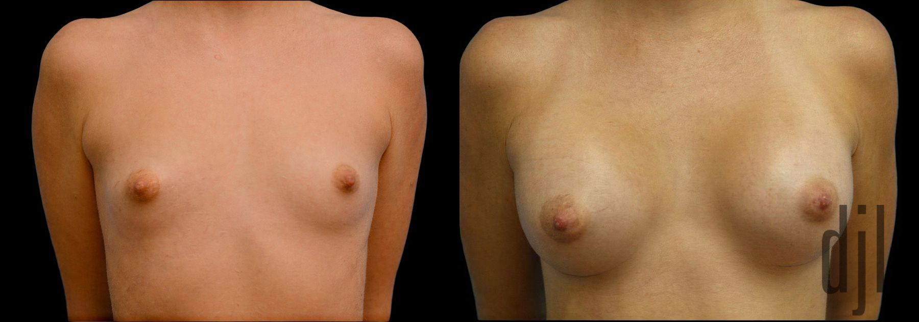Before and after Breast Augmentation case 42926