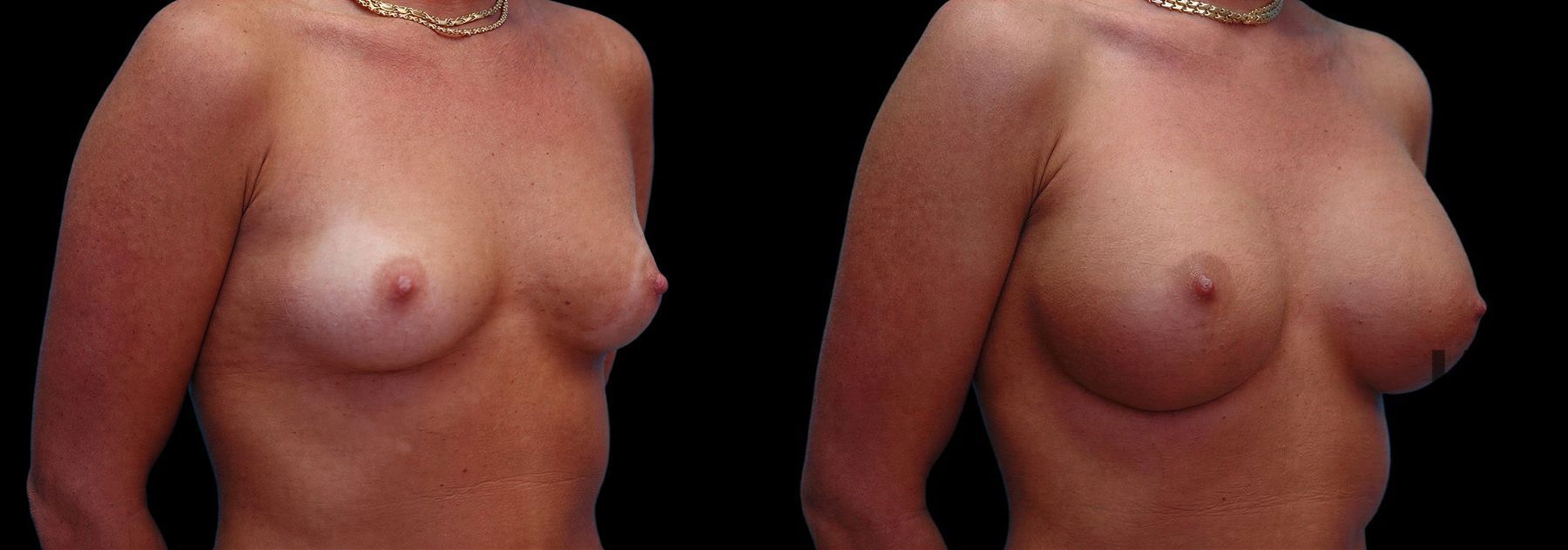 Before and after Breast Augmentation case 42570 - Angle 2