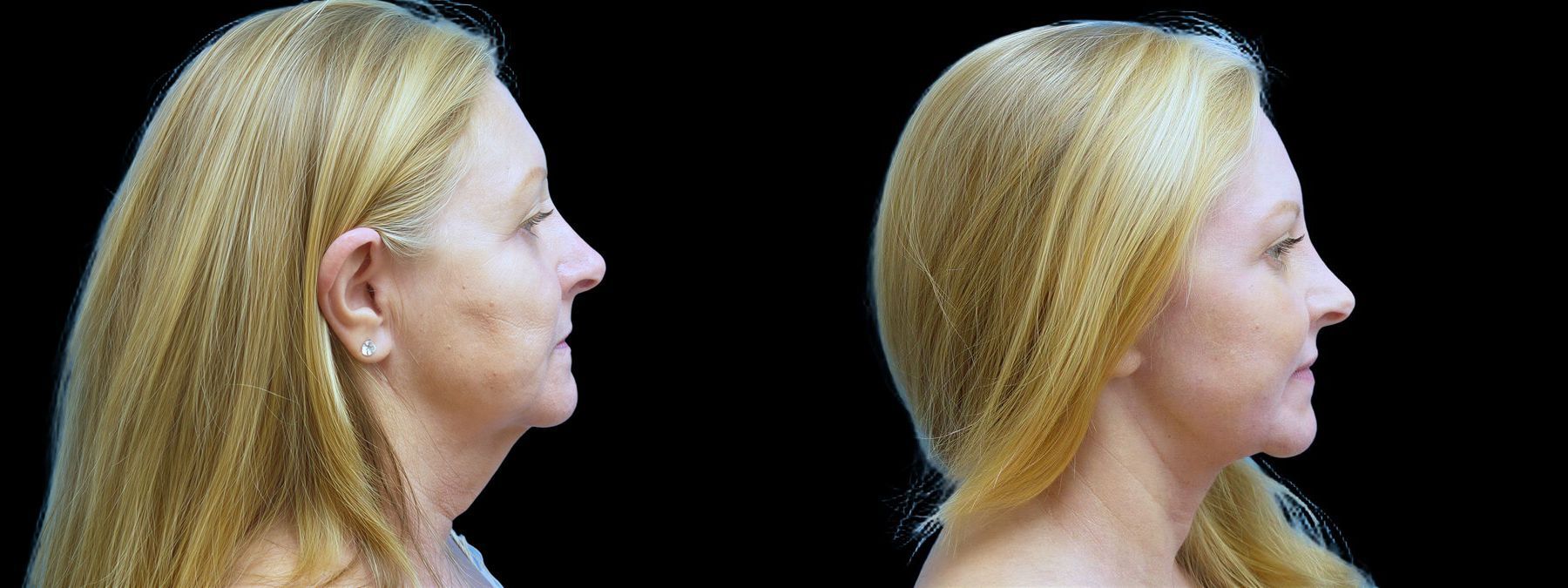 Before and after Facelift case 42784 - Angle 2