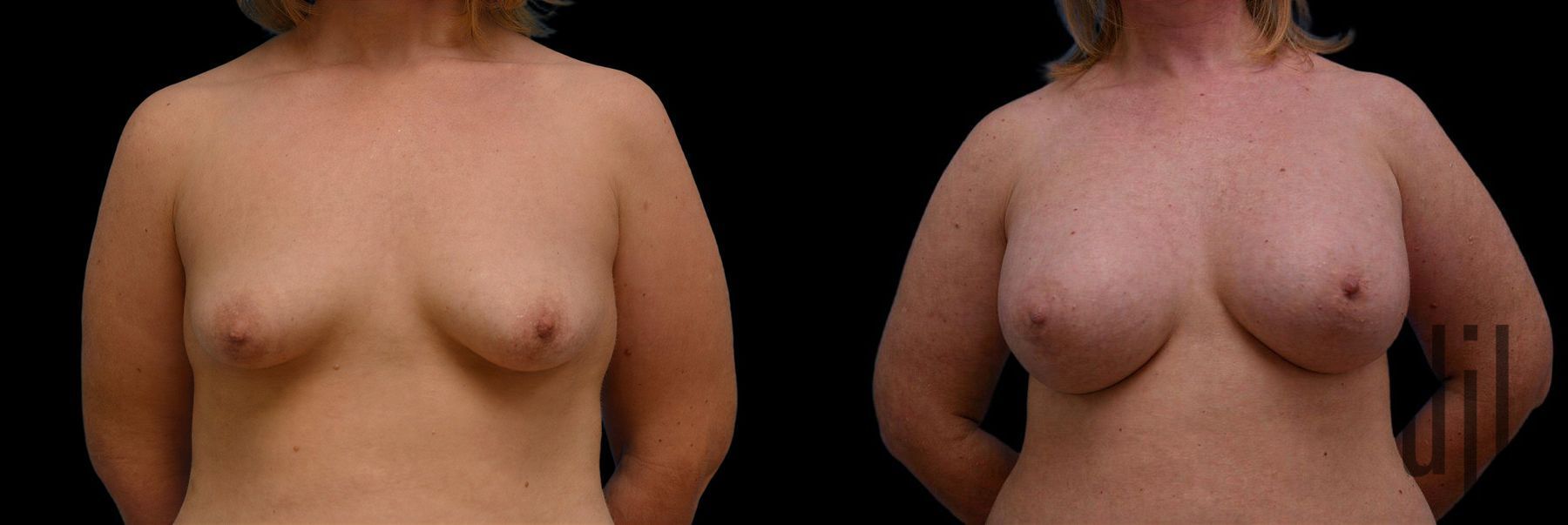 Before and after Breast Augmentation case 42899