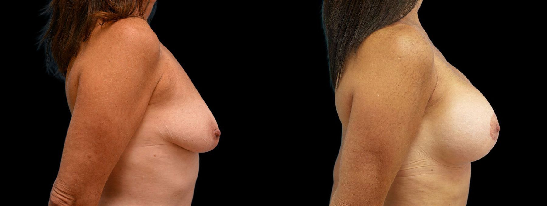 Before and after Breast Augmentation with Lift case 42787 - Angle 2