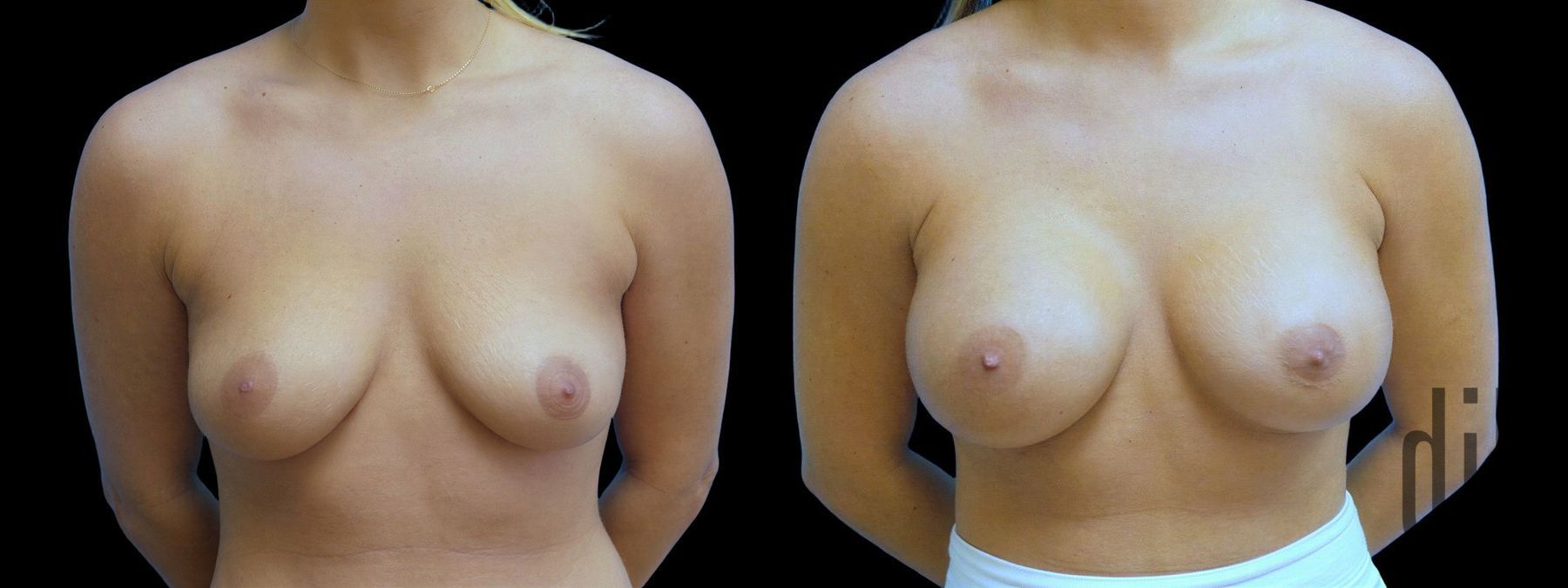 Before and after Breast Augmentation case 42961
