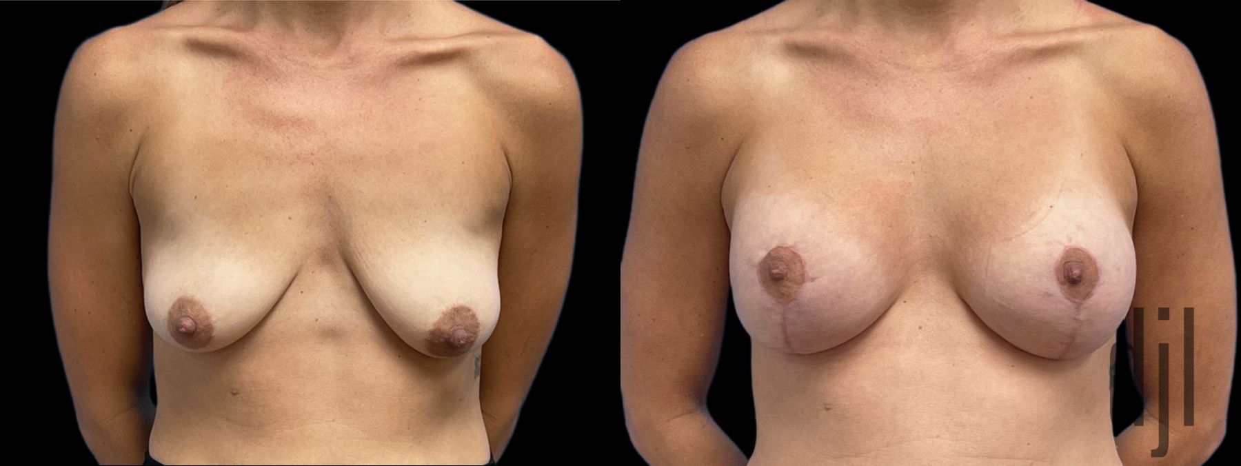 Before and after Breast Augmentation with Lift case 41233