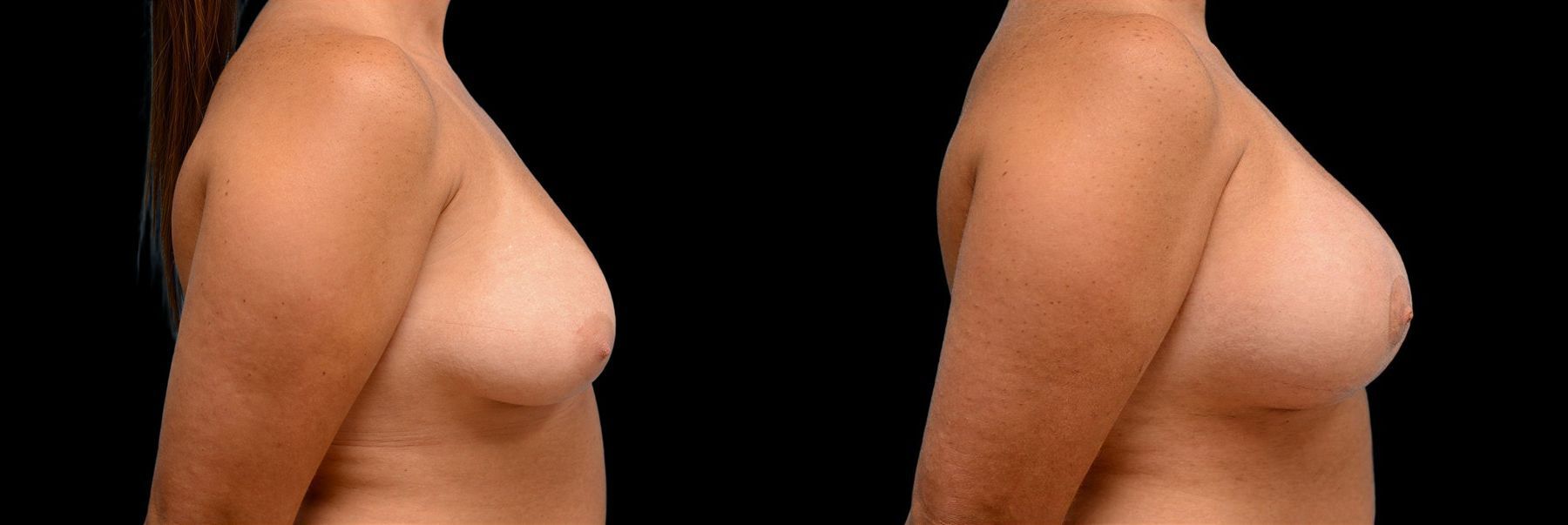 Before and after Breast Augmentation with Lift case 42846 - Angle 2