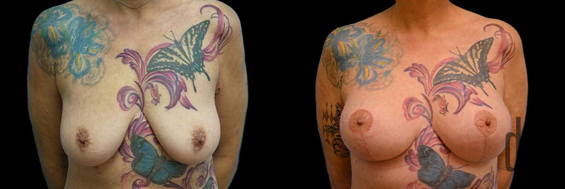 Before and after Breast Augmentation with Lift case 42821
