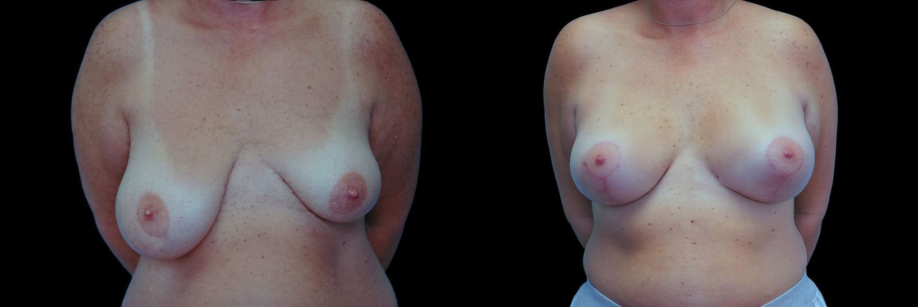 Before and after Breast Augmentation with Lift case 42830