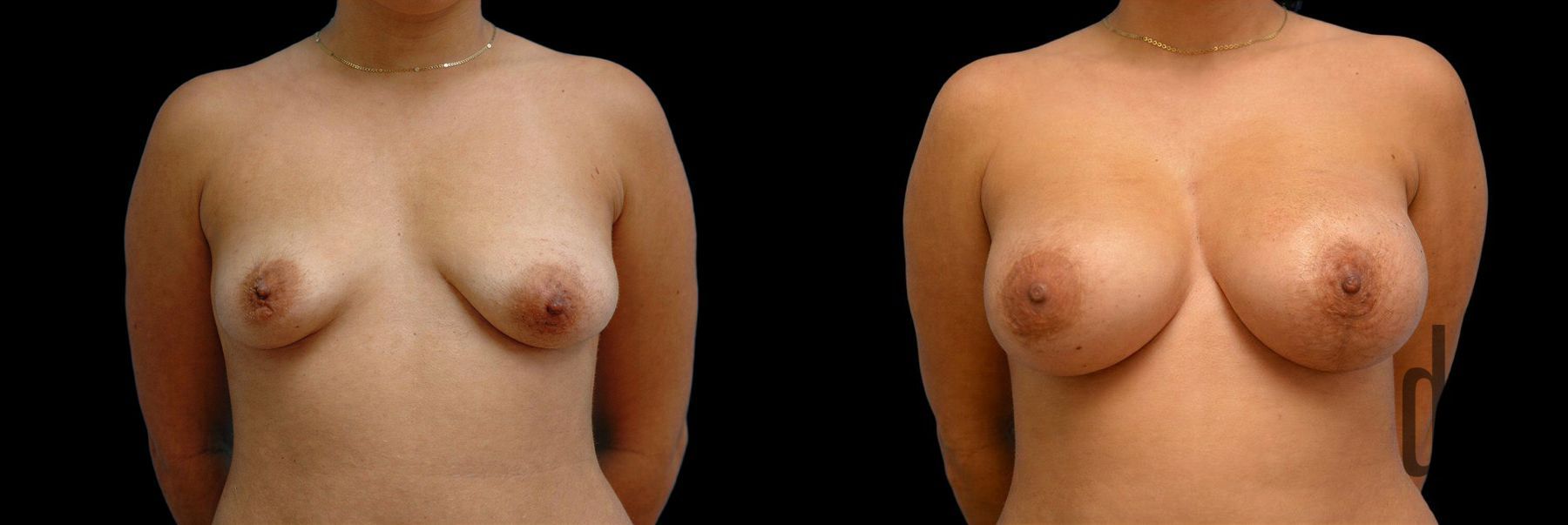Before and after Breast Augmentation with Lift case 42701
