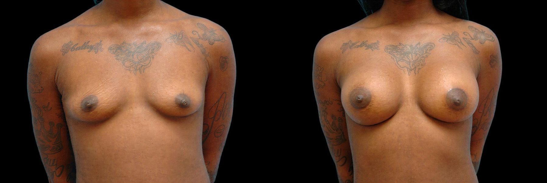 Before and after Breast Augmentation case 42765