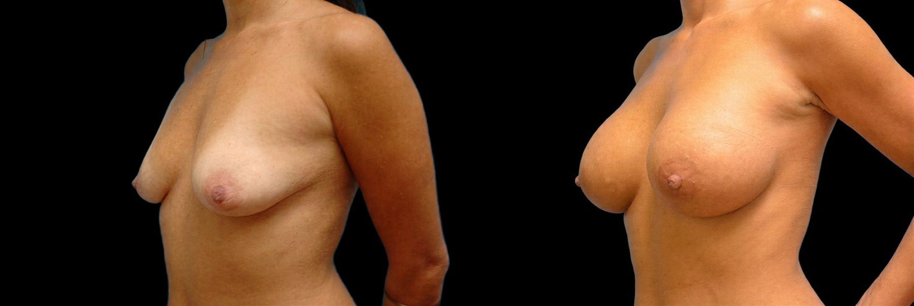 Before and after Breast Augmentation case 42840 - Angle 2