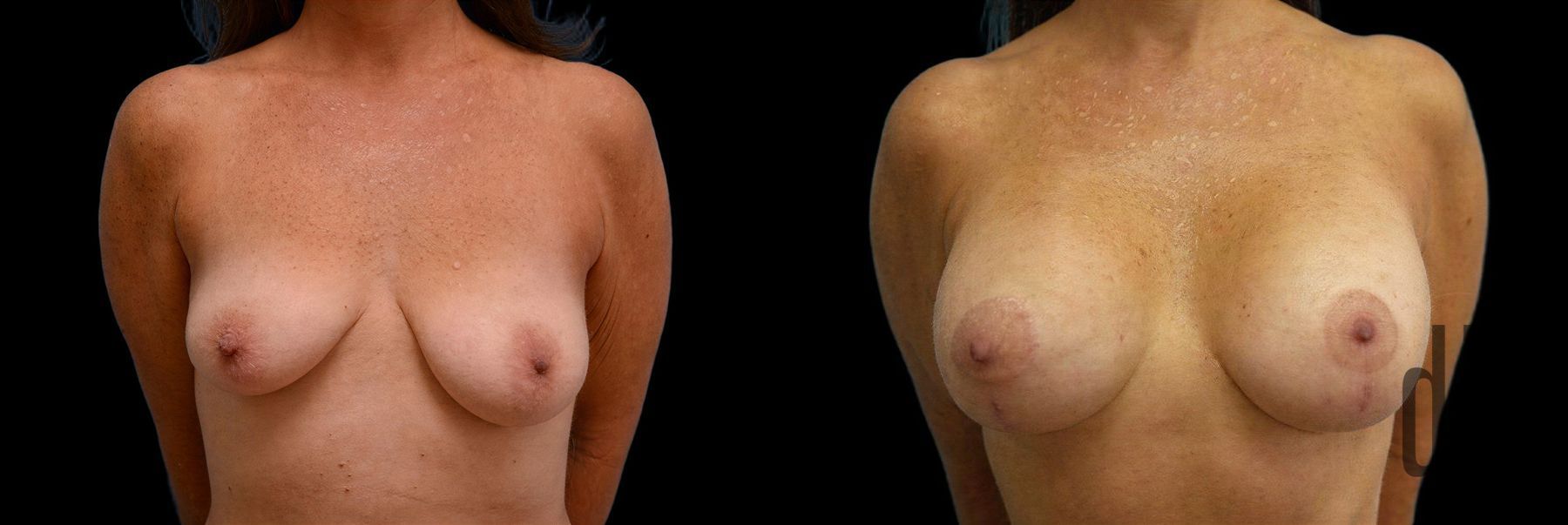 Before and after Breast Augmentation with Lift case 42787