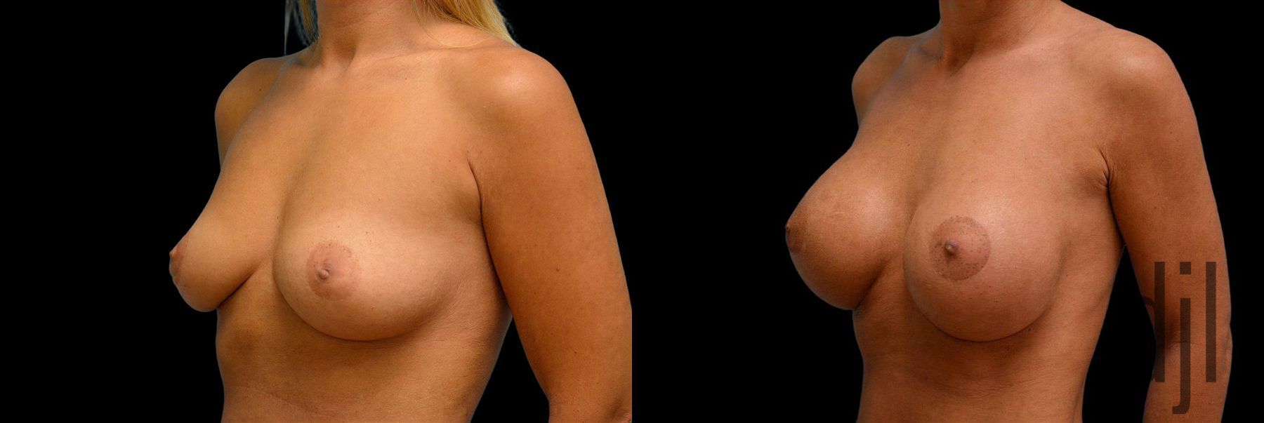 Before and after Breast Augmentation case 42883