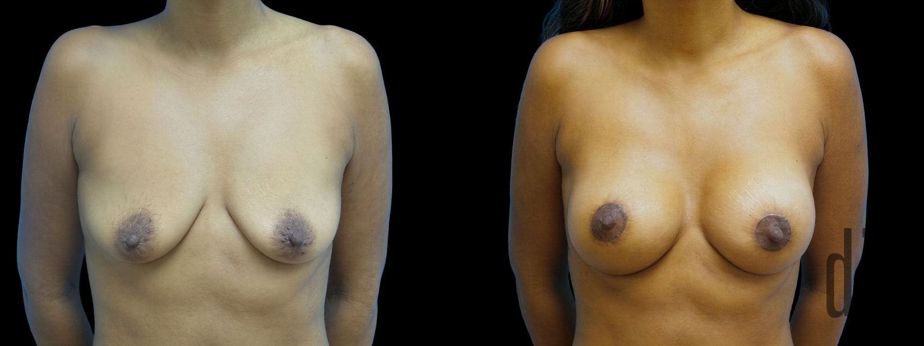 Before and after Breast Augmentation with Lift case 42870